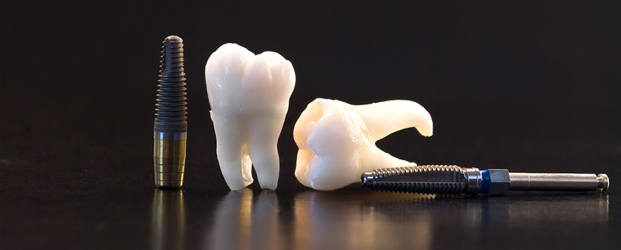 سؤالات مهم در خصوص ایمپلنت دندان