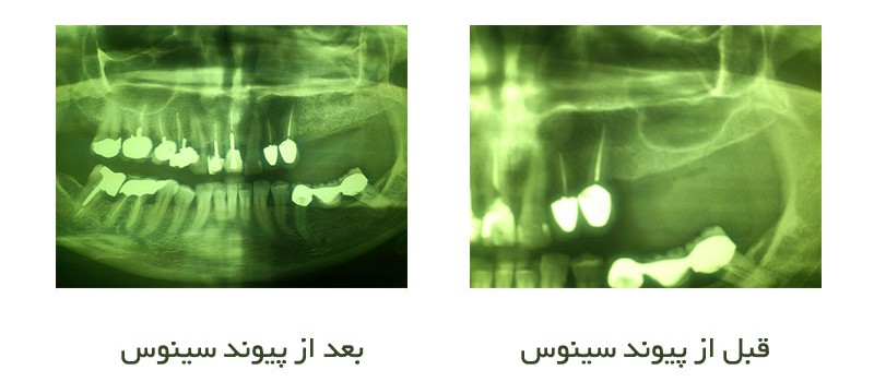 جراحی پیوند سینوس