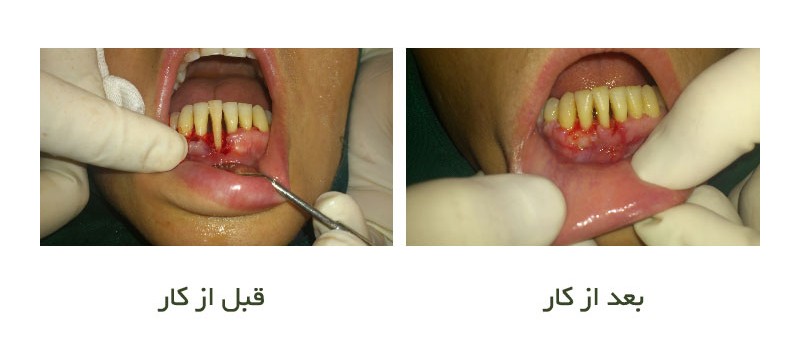 قبل و بعد از عمل جراحی لثه