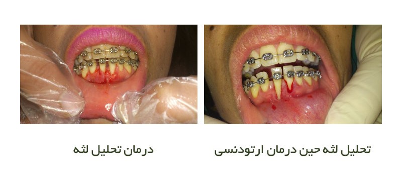 درمان تحلیل لثه حین ارتودنسی